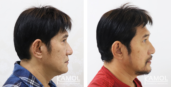 Jaw Augmentation