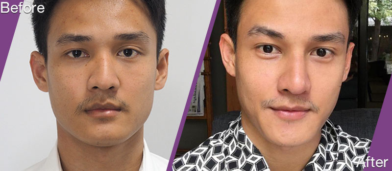 before_and_after_Rhinoplasty_for_International_look.