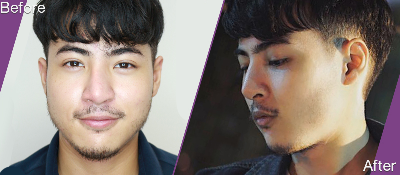 before_and_after_Rhinoplasty 