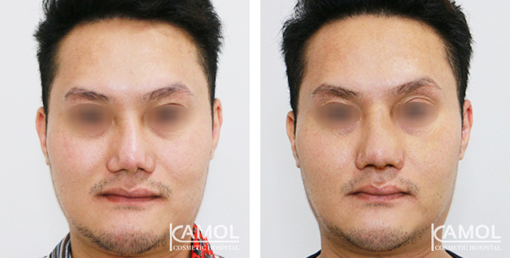 Before_&_After_Rhinoplasty