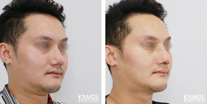 Before_&_After_Rhinoplasty
