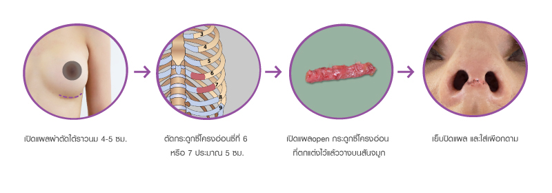 เทคนิคการเสริมจมูกด้วยกระดูกซี่โครง_ของโรงพยาบาลศัลยกรรมตกแต่งกมล