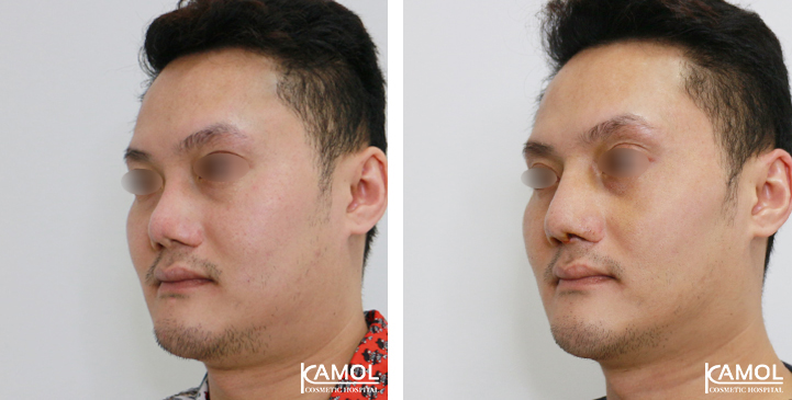 Before  & After Rhinoplasty