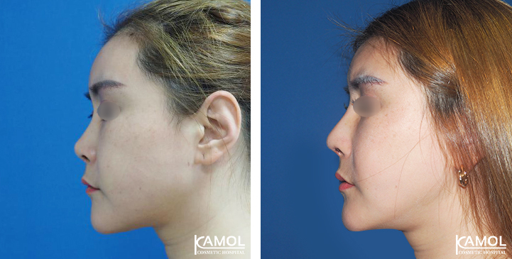 Before  & After Rhinoplasty