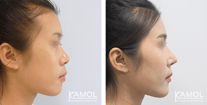 Before_&_After_Rhinoplasty