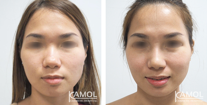 Before_&_After_Rhinoplasty