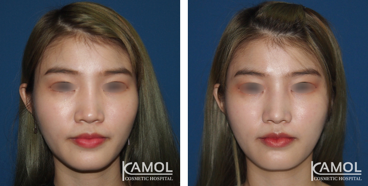 Before_&_After_Rhinoplasty