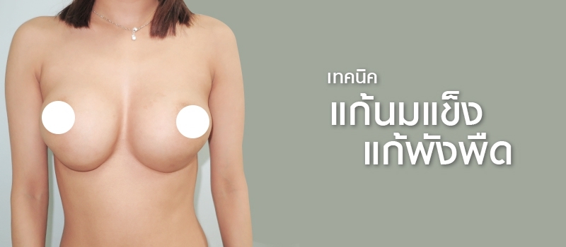 Surgical_techniques_to_fix_capsular_contracture_in_breast_implant