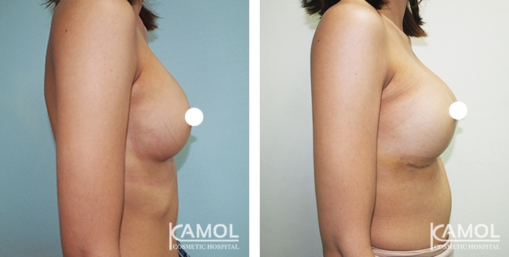 Before and After Reconstruction surgery to fix symmastia uniboob