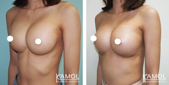 Before and After Reconstruction surgery to fix symmastia uniboob