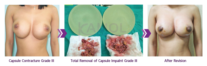 Capsular_Contracture