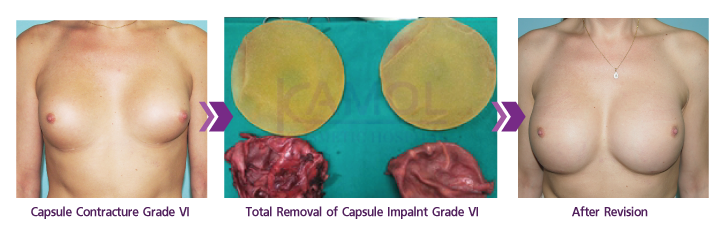 Capsular_Contracture