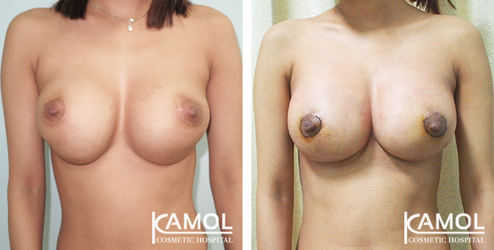 Before_and_After_Capsular_Contracture_Revision_Surgery