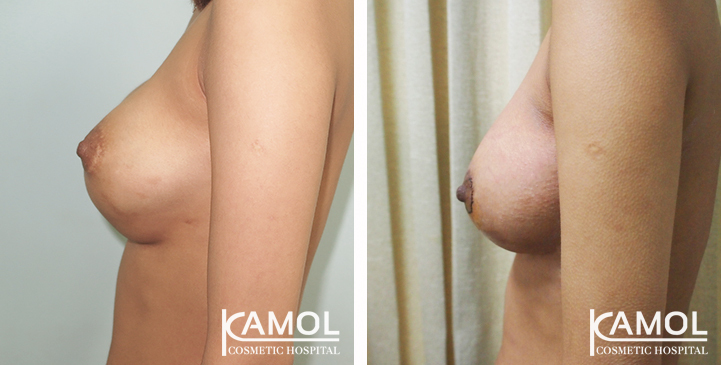 Before_and_After_Capsular_Contracture_Revision_Surgery