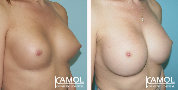 Before_and_After_Capsular_Contracture_Revision_Surgery