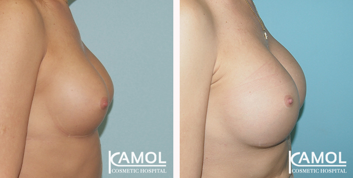 Before_and_After_Capsular_Contracture_Revision_Surgery