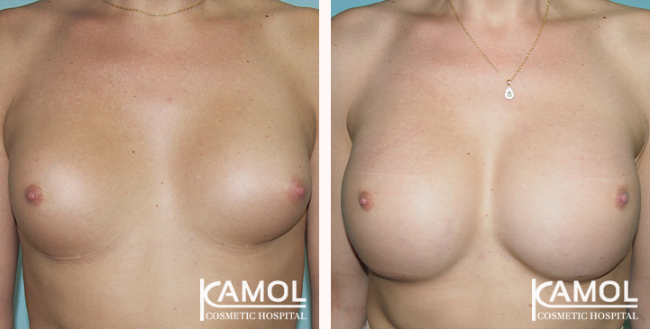 Before and After Reconstruction surgery to fix symmastia uniboob