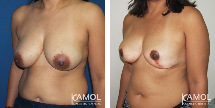 Before_and_After_surgery_2_weeks_Breast_Reduction_by_inverted_T-scar