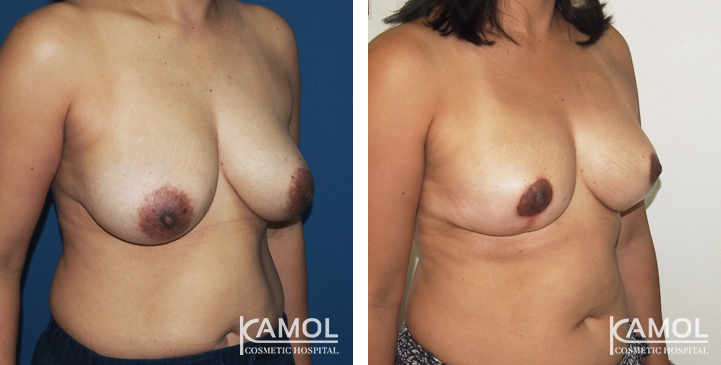 Before_and_After_surgery_2_weeks_Breast_Reduction_by_inverted_T-scar