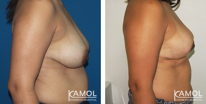 Before_and_After_surgery_2_weeks_Breast_Reduction_by_inverted_T-scar