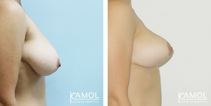 Before_and_After_surgery_1_month_Breast_Reduction_by_inverted_T-scar