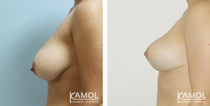Before_and_After_surgery_1_month_Breast_Reduction_by_inverted_T-scar