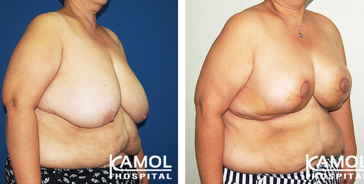 The importance of BMI In relation to Breast Reduction Surgery