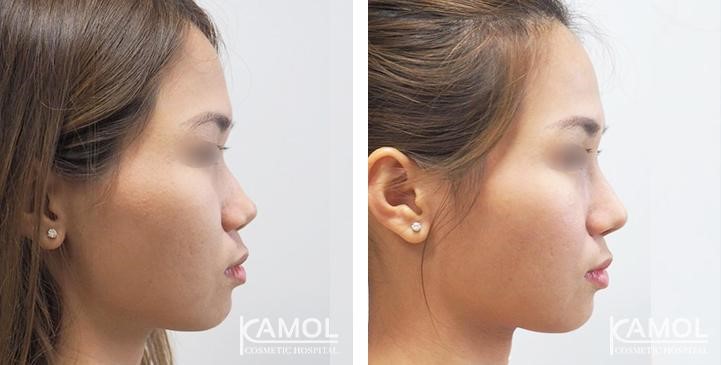 Before_and_After_pictures_of_patients_having_e-PTFE_Gore-Tex®_rhinoplasty.