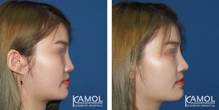 Before_and_After_pictures_of_patients_having_e-PTFE_Gore-Tex®_rhinoplasty.