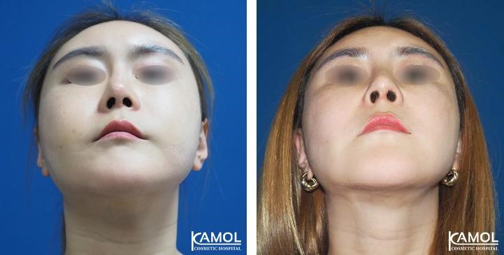 Before_and_after_images_of_patient_with_rib_cartilage_rhinoplasty