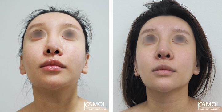 Before_and_after_images_of_patient_with_rib_cartilage_rhinoplasty