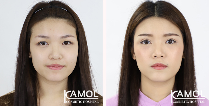 Before & After Aging Upper Blepharoplasty, Upper Eyelid Surgery