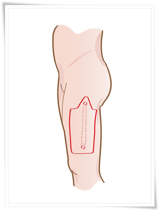 Picture 1: ALT-Pedicle Flap Phalloplasty