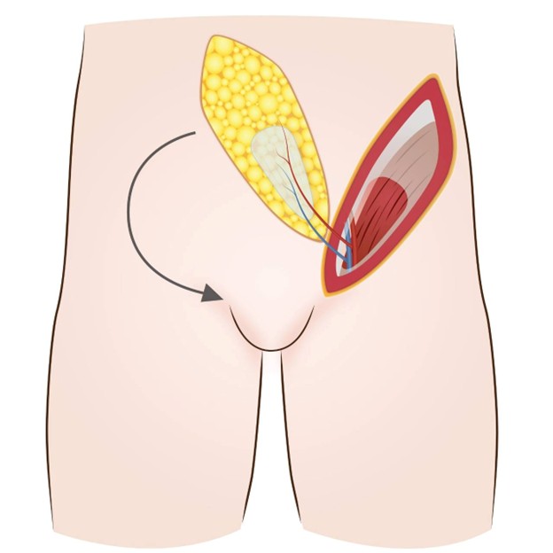 Picture 3: SCIP Phalloplasty