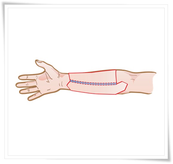 Picture 4: Radial forearm Phalloplasty