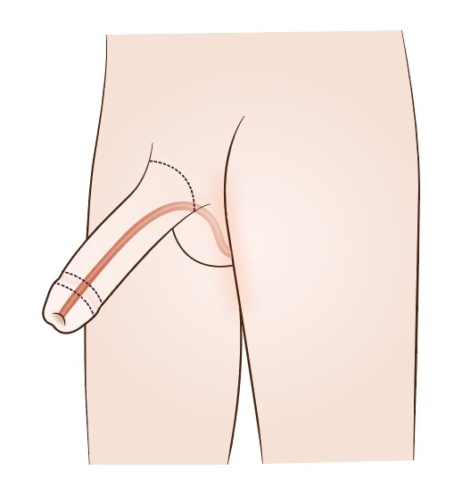 Picture 8: Phalloplasty with full urethral reconstruction