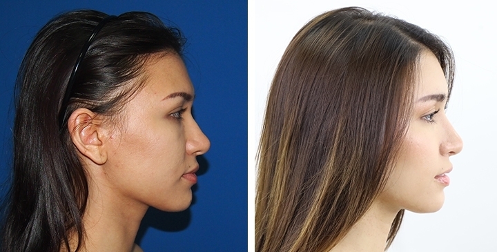 Before and After Cheekbone Augmentation