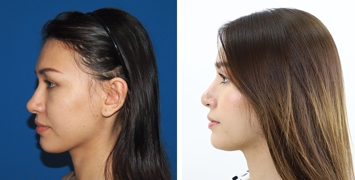 Before and After Cheekbone Augmentation