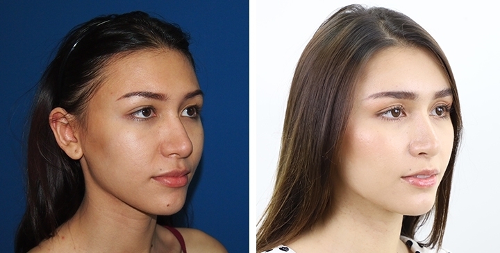 Before and After Cheekbone Augmentation