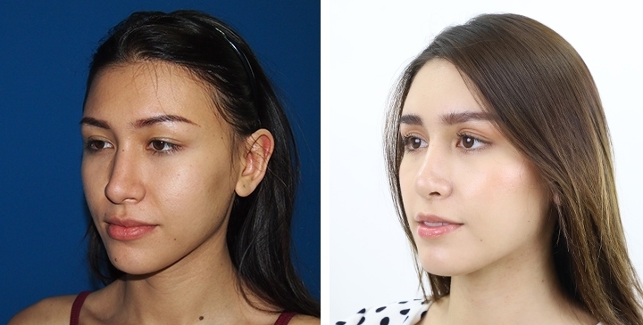 Before and After Cheekbone Augmentation