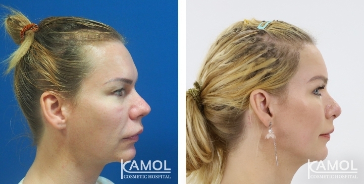 Avant & Après Chirurgie du visage / Remodelage du visage