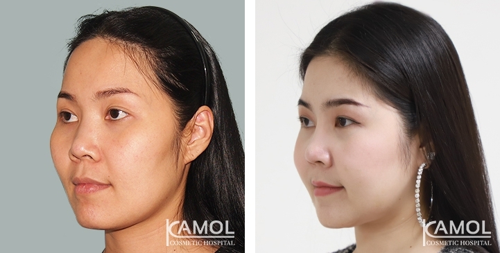 Avant et après la chirurgie de réduction de la mâchoire / Rasage de la mâchoire