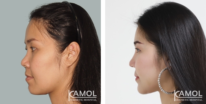 Avant et après la chirurgie de réduction de la mâchoire / Rasage de la mâchoire