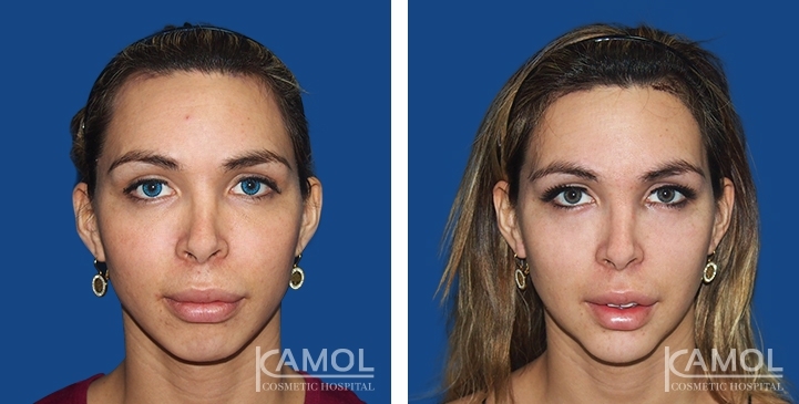 Avant & Après Remodelage du front, modelage des sourcils, réduction des sourcils
