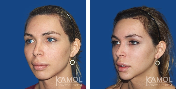 Avant & Après Remodelage du front, modelage des sourcils, réduction des sourcils