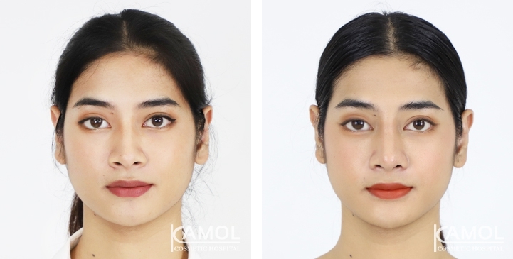 Before & After Revision Rhinoplasty