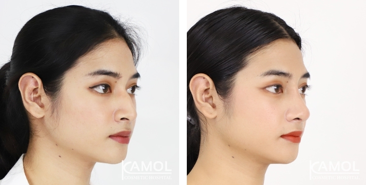 Before & After Revision Rhinoplasty