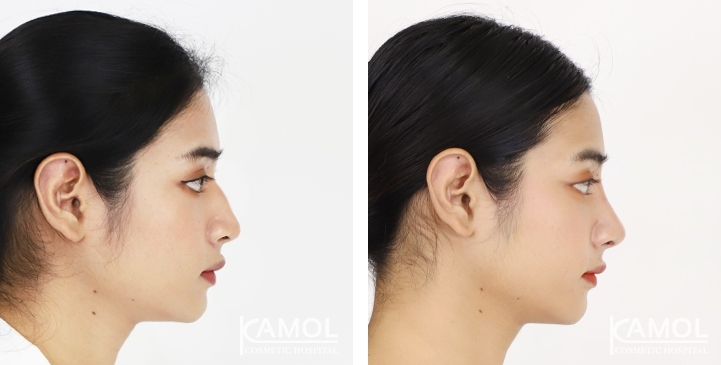 Before & After Revision Rhinoplasty