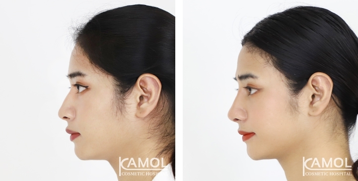 Before & After Revision Rhinoplasty