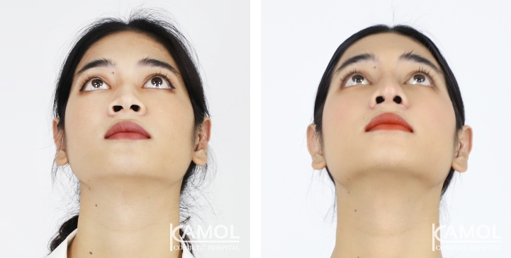 Before & After Revision Rhinoplasty